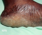 tinea pedis