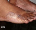 tinea pedis