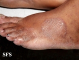 tinea pedis