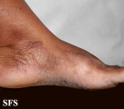 tinea pedis