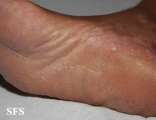 tinea pedis