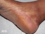 tinea pedis