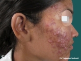 acne-topical corticosteroids