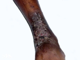 eczema microbic
