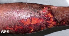 eczema microbic