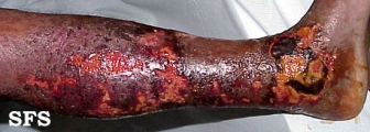 eczema microbic