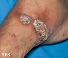 chromomycosis