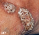 chromomycosis