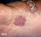 chromomycosis