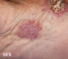 chromomycosis