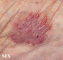 chromomycosis