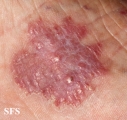 chromomycosis