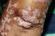 chromomycosis