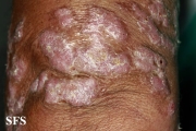 chromomycosis