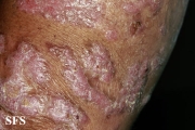 chromomycosis