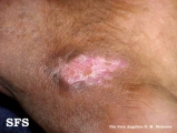 chromomycosis