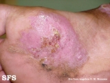 chromomycosis