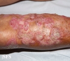 chromomycosis