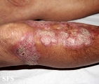 chromomycosis
