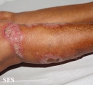 chromomycosis