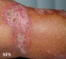 chromomycosis