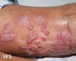 chromomycosis