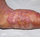 chromomycosis