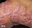 chromomycosis
