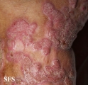 chromomycosis