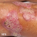 chromomycosis