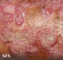 chromomycosis