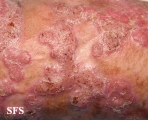 chromomycosis