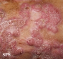 chromomycosis