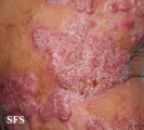 chromomycosis