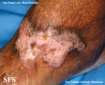 chromomycosis