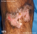 chromomycosis