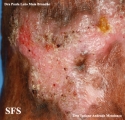 chromomycosis
