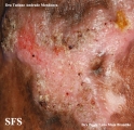 chromomycosis