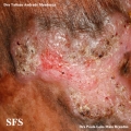 chromomycosis