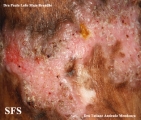 chromomycosis