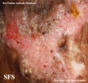 chromomycosis