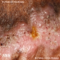 chromomycosis