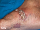 chromomycosis