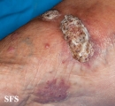 chromomycosis