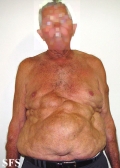 lipomatosis-multiple symmetric lipomatosis