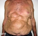 lipomatosis-multiple symmetric lipomatosis