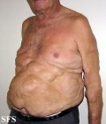 lipomatosis-multiple symmetric lipomatosis