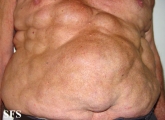 lipomatosis-multiple symmetric lipomatosis