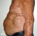 lipomatosis-multiple symmetric lipomatosis