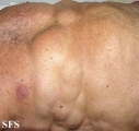 lipomatosis-multiple symmetric lipomatosis